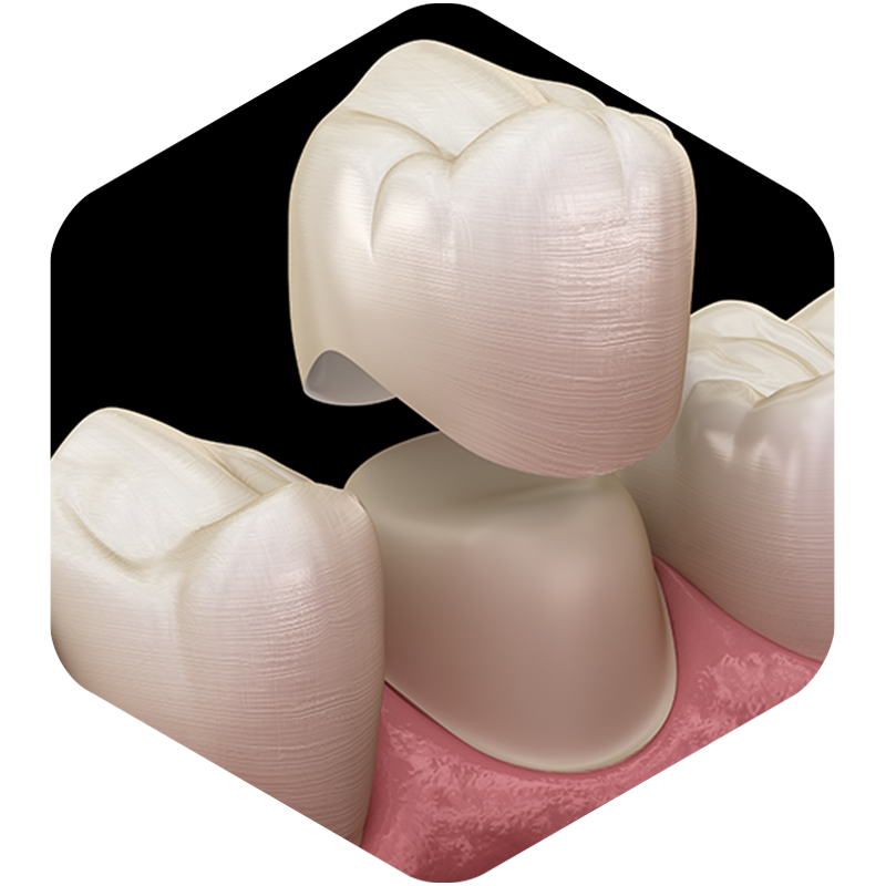 A 3D illustration of a crown being placed.